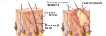 Угревая сыпь – почему она возникает?