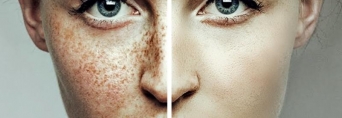 Гіперпігментація: причини виникнення та методи лікування