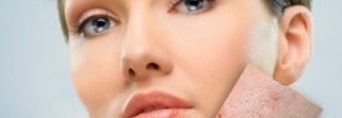 Постакне: причины и методы лечения постакне